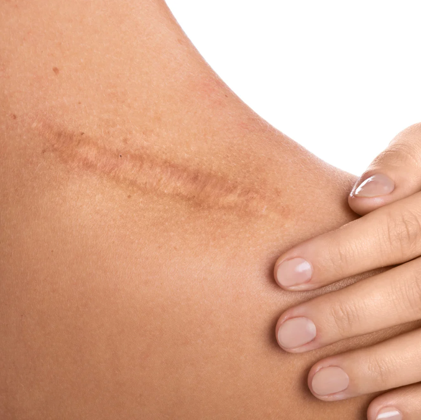 How to Correct Scars with the I'm Fabulous Cosmetics TCA Body Peel, Microneedling Pen, and High-Tech Copper Peptide Serum