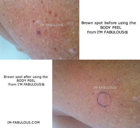 TCA Lactic & Glycolic Body Peel | Exfoliating, Skin Resurfacing & Firming Peel for Smooth, Radiant Skin