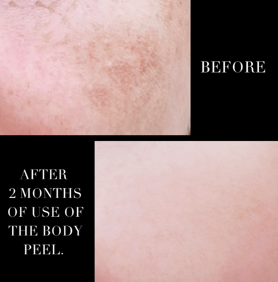 TCA Lactic & Glycolic Body Peel | Exfoliating, Skin Resurfacing & Firming Peel for Smooth, Radiant Skin