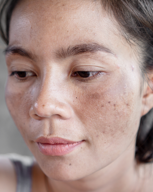 How to Treat Hyperpigmentation and Sun Damage Naturally with Plant-Based Skincare That Works