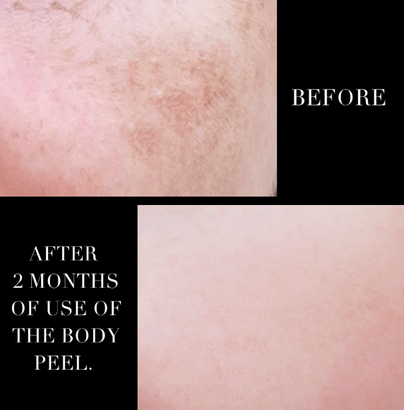 TCA LACTIC & GLYCOLIC BODY PEEL